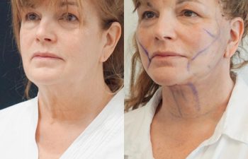 Eden Plastic Surgery Institute female patient's face before and after Eve lift procedure.