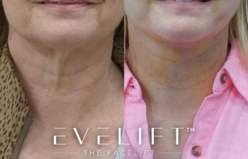 Eden Plastic Surgery Institute female patient's face before and after Eve lift procedure.