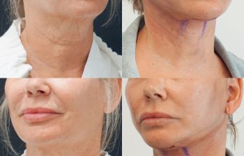 Eden Plastic Surgery Institute female patient's face before and after Eve lift procedure.