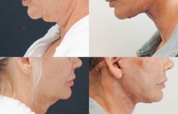 Eden Plastic Surgery Institute female patient's face before and after Eve lift procedure.