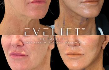 Eden Plastic Surgery Institute female patient's face before and after Eve lift procedure.