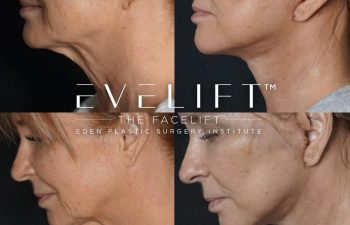 Eden Plastic Surgery Institute female patient's face before and after Eve lift procedure.