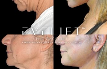 Eden Plastic Surgery Institute female patient's face before and after Eve lift procedure.