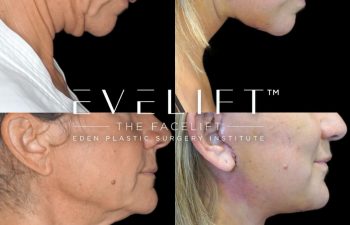 Eden Plastic Surgery Institute female patient's face before and after Eve lift procedure.