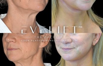 Eden Plastic Surgery Institute female patient's face before and after Eve lift procedure.