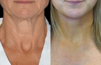 Eden Plastic Surgery Institute female patient's face before and after Eve lift procedure.