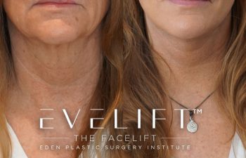 Eden Plastic Surgery Institute female patient's face before and after Eve lift procedure.