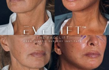 Eden Plastic Surgery Institute female patient's face before and after Eve lift procedure.