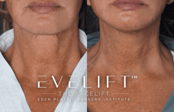 Eden Plastic Surgery Institute female patient's face before and after Eve lift procedure.