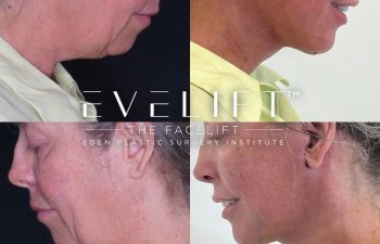 Eden Plastic Surgery Institute female patient's face before and after Eve lift procedure.