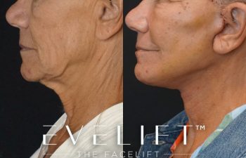 Eden Plastic Surgery Institute female patient's face before and after Eve lift procedure.