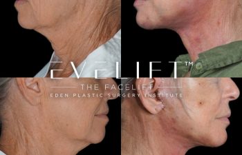 Eden Plastic Surgery Institute female patient's face before and after Eve lift procedure.