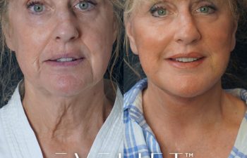 Eden Plastic Surgery Institute female patient's face before and after Eve lift procedure.