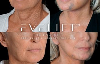 Eden Plastic Surgery Institute female patient's face before and after Eve lift procedure.