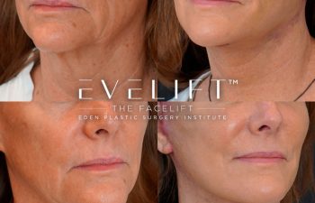 Eden Plastic Surgery Institute female patient's face before and after Eve lift procedure.