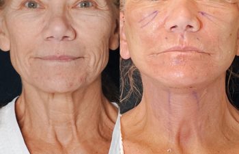 Eden Plastic Surgery Institute female patient's face before and after Eve lift procedure.