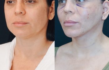 Eden Plastic Surgery Institute female patient's face before and after Eve lift procedure.