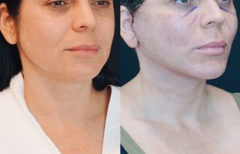 Eden Plastic Surgery Institute female patient's face before and after Eve lift procedure.