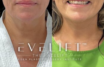 Eden Plastic Surgery Institute female patient's face before and after Eve lift procedure.