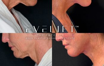 Eden Plastic Surgery Institute female patient's face before and after Eve lift procedure.