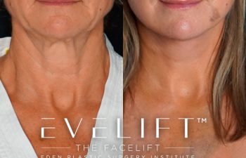 Eden Plastic Surgery Institute female patient's face before and after Eve lift procedure.
