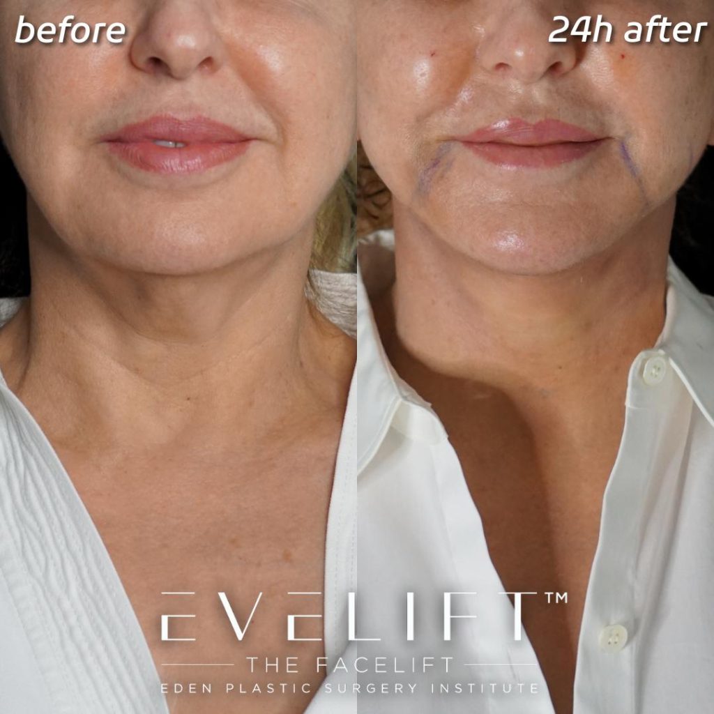 Eden Plastic Surgery Institute female patient's face before and after Eve lift procedure.