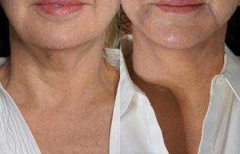 Eden Plastic Surgery Institute female patient's face before and after Eve lift procedure.