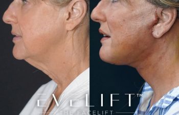 Eden Plastic Surgery Institute female patient's face before and after Eve lift procedure.