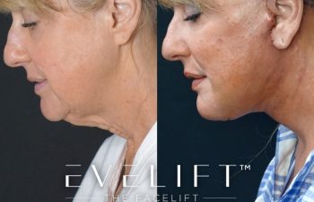 Eden Plastic Surgery Institute female patient's face before and after Eve lift procedure.