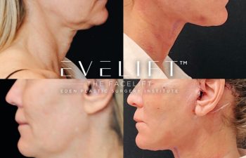 Eden Plastic Surgery Institute female patient's face before and after Eve lift procedure.