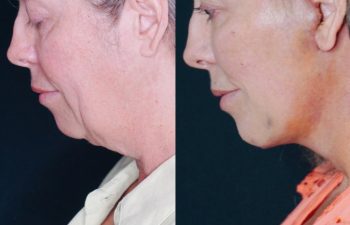 Eden Plastic Surgery Institute female patient's face before and after Eve lift procedure.