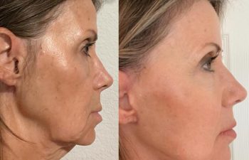 Eden Plastic Surgery Institute female patient's face before and after Eve lift procedure.