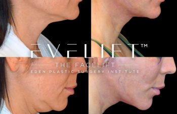 Eden Plastic Surgery Institute female patient's face before and after Eve lift procedure.