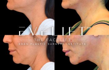 Eden Plastic Surgery Institute female patient's face before and after Eve lift procedure.