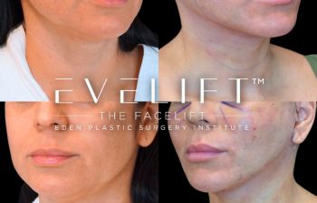 Eden Plastic Surgery Institute female patient's face before and after Eve lift procedure.