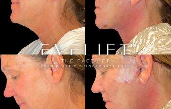 Eden Plastic Surgery Institute female patient's face before and after Eve lift procedure.