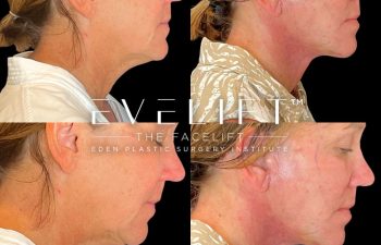 Eden Plastic Surgery Institute female patient's face before and after Eve lift procedure.