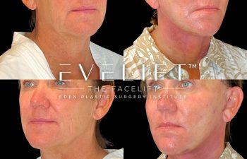 Eden Plastic Surgery Institute female patient's face before and after Eve lift procedure.