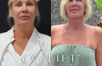 Eden Plastic Surgery Institute female patient's face before and after Eve lift procedure.