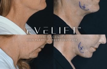 Eden Plastic Surgery Institute female patient's face before and after Eve lift procedure.