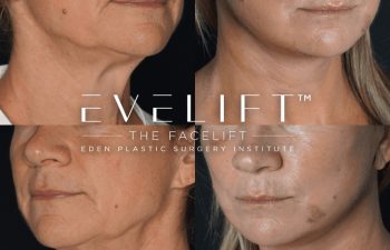 Eden Plastic Surgery Institute female patient's face before and after Eve lift procedure.