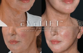 Eden Plastic Surgery Institute female patient's face before and after Eve lift procedure.