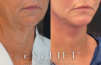 Eden Plastic Surgery Institute female patient's face before and after Eve lift procedure.