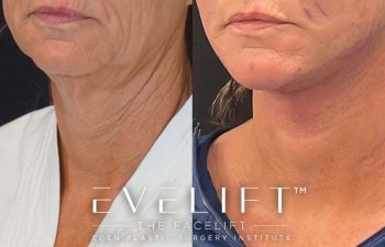 Eden Plastic Surgery Institute female patient's face before and after Eve lift procedure.
