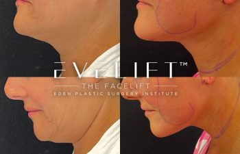Eden Plastic Surgery Institute female patient's face before and after Eve lift procedure.