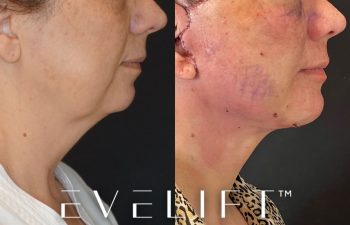 Eden Plastic Surgery Institute female patient's face before and after Eve lift procedure.