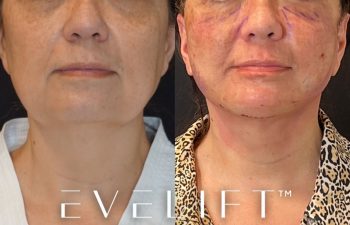 Eden Plastic Surgery Institute female patient's face before and after Eve lift procedure.