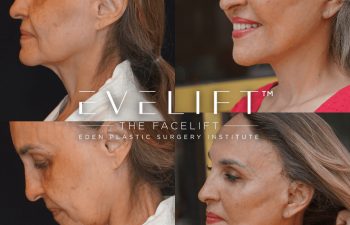 Eden Plastic Surgery Institute female patient's face before and after Eve lift procedure.