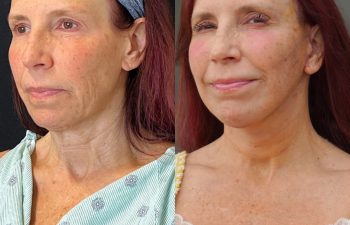 Eden Plastic Surgery Institute female patient's face before and after Eve lift procedure.