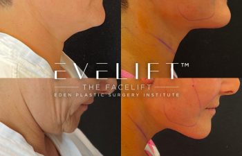 Eden Plastic Surgery Institute female patient's face before and after Eve lift procedure.